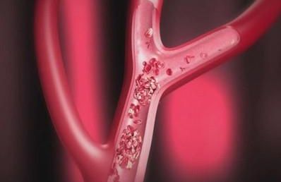 低铁水平可能会增加静脉血栓风险。