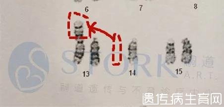 W女士的一条14号染色体与13号染色体接合在一起