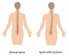 夏吉布斯综合症( Xia-Gibbs syndrome)是什么